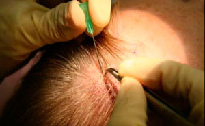 plantar-pelo-en-cabeza